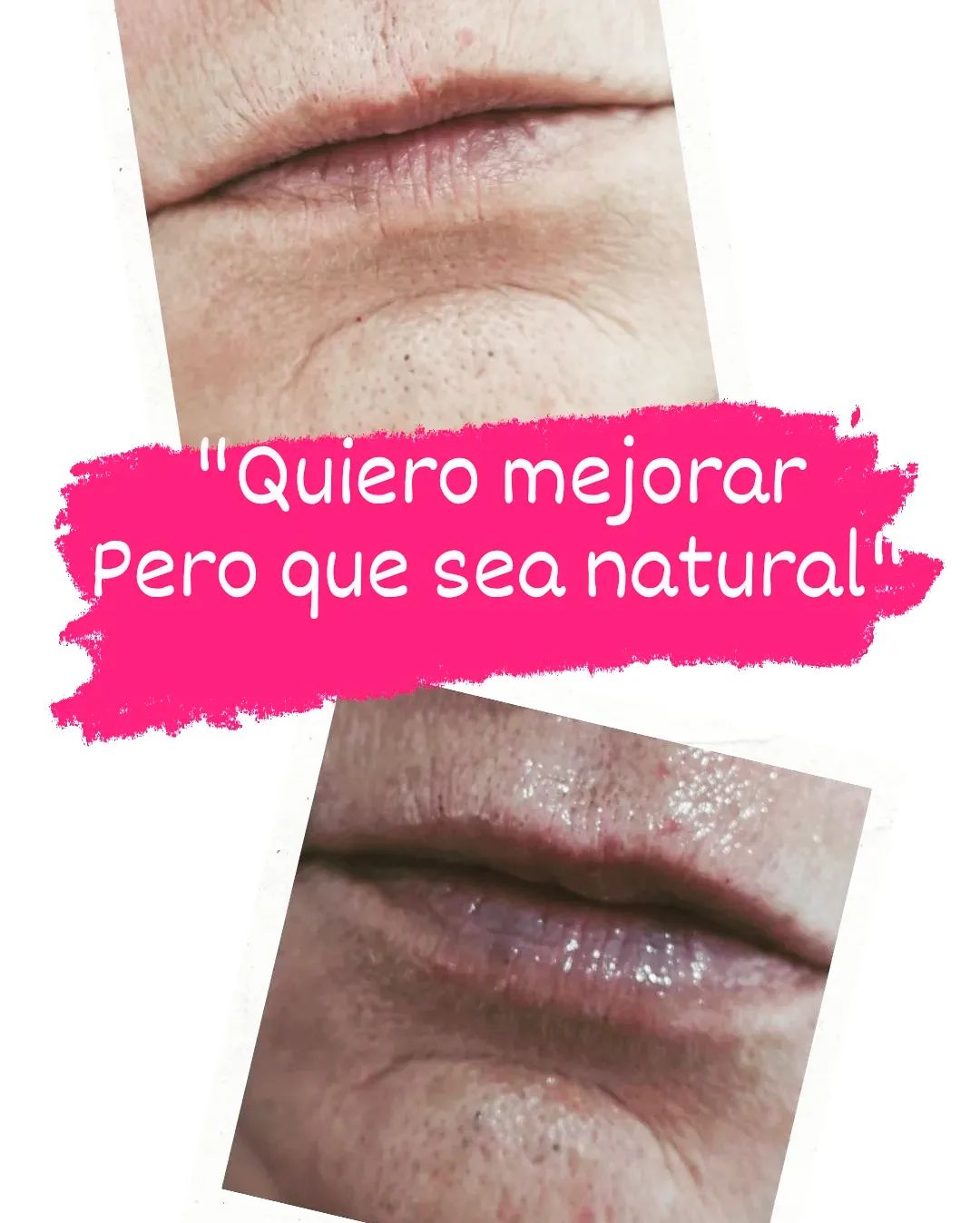 Clinica Dra. Silvina Ciberti - Labios diferentes! Diferentes edades ...