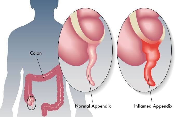 Health - Appendicitis is inflammation of the appendix, a small pouch ...