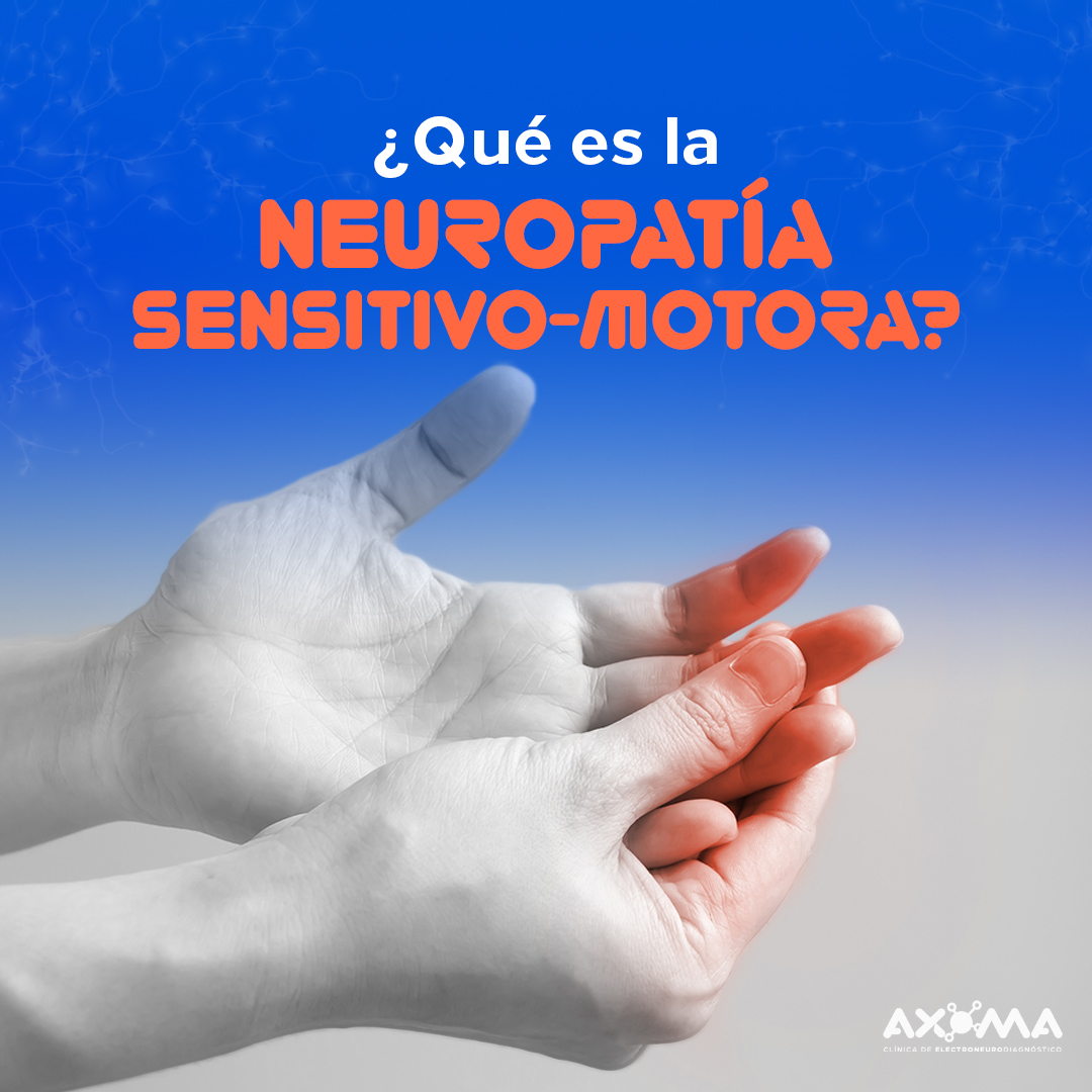 Axoma - La neuropatía sensitivo motora es un padecimiento...