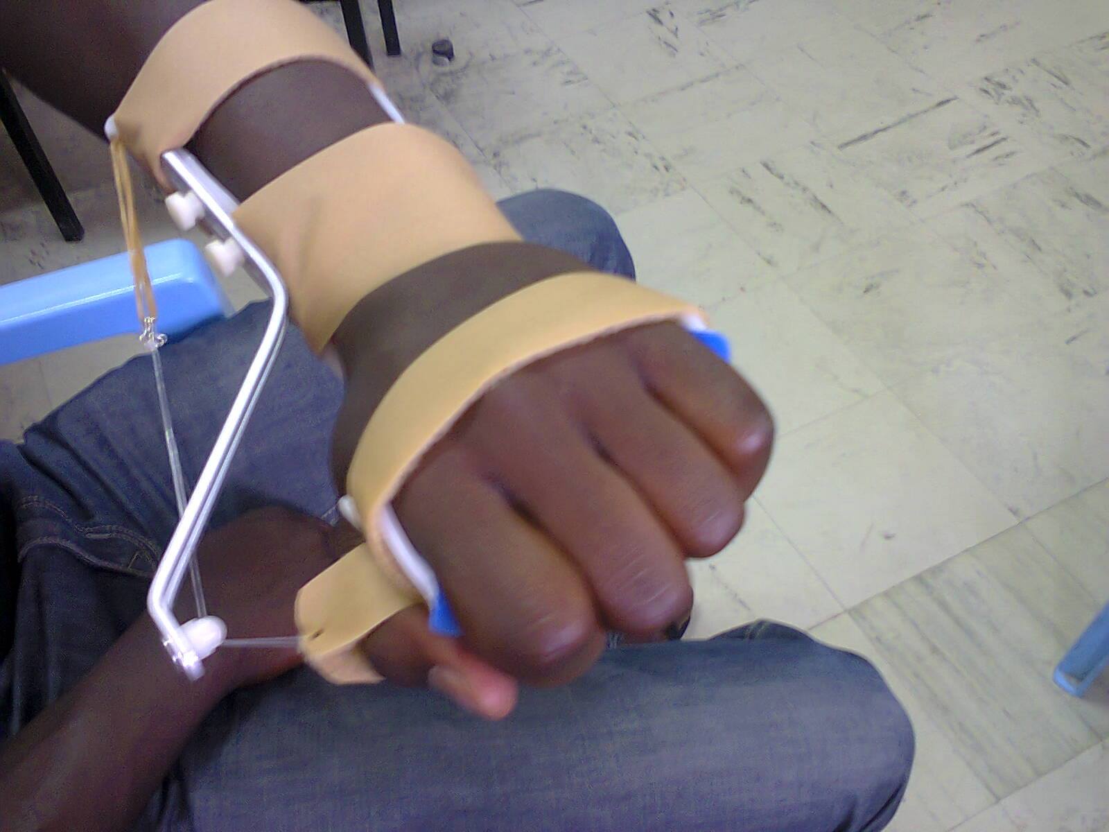 Functional Radial nerve palsy splint - Hand Therapy-Kenya | Facebook