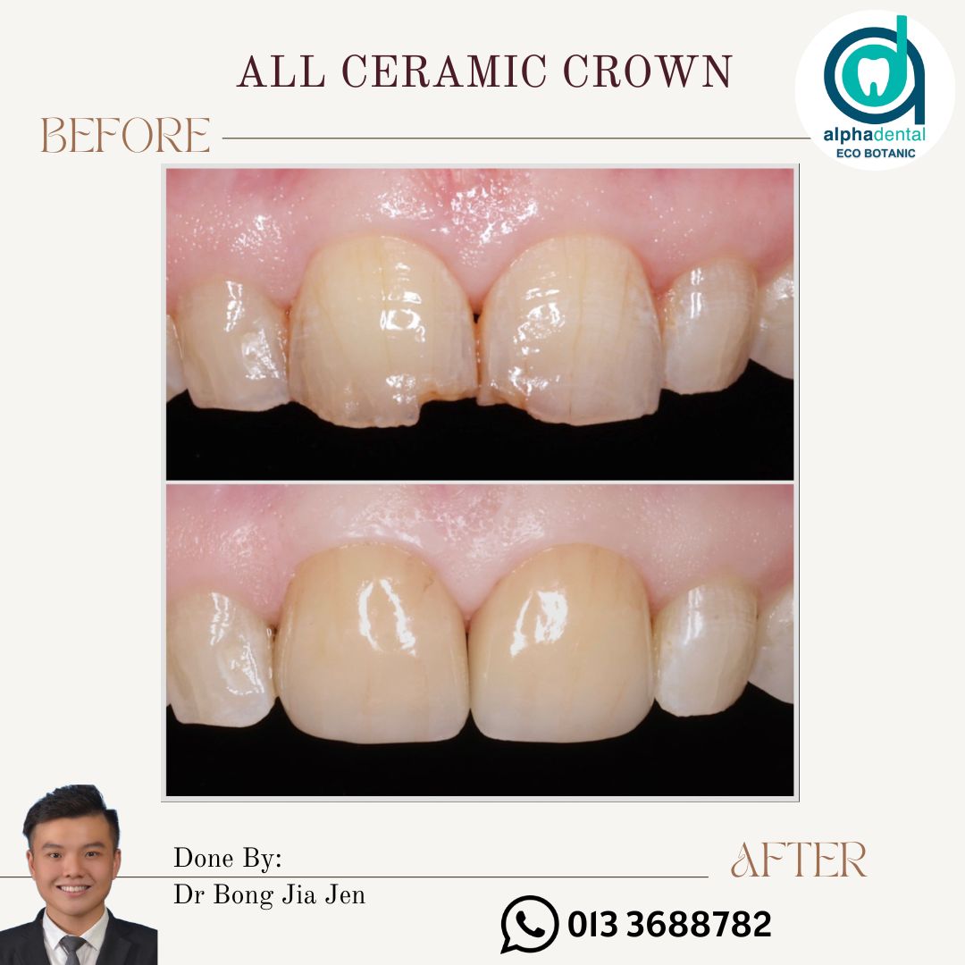 Alpha - New crown, new confidence 👑🦷 A crown restores the tooth’s shape ...