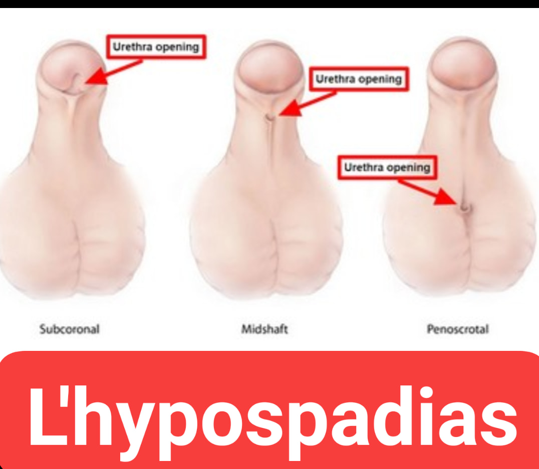 Afrik Health Tv L Hypospadias Qu Est Ce Que Facebook