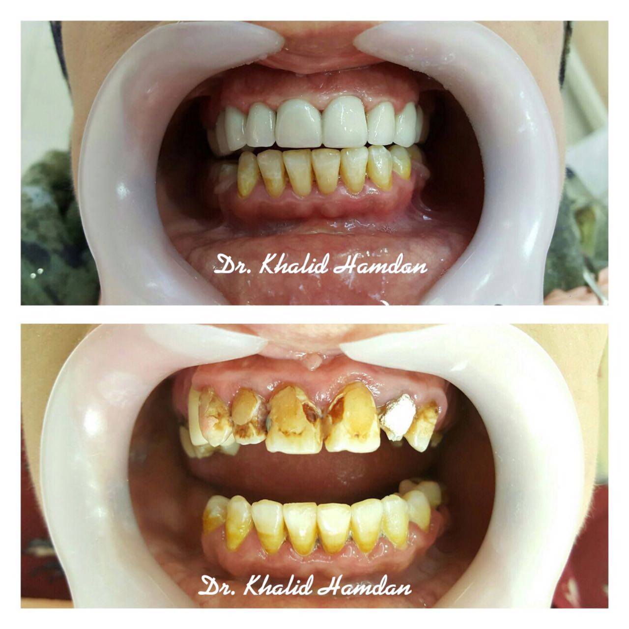 Dr. - تسوسات وتهدم في بعض الاسنان واجري سحب عصب لاغلب الاسنان وبناء ...