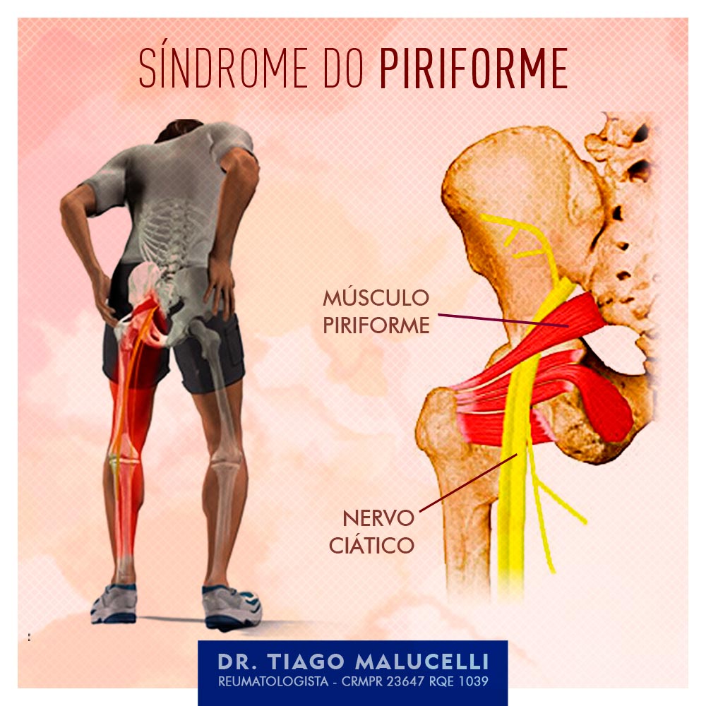 A síndrome do piriforme é um... - Dr. Tiago Malucelli | Facebook