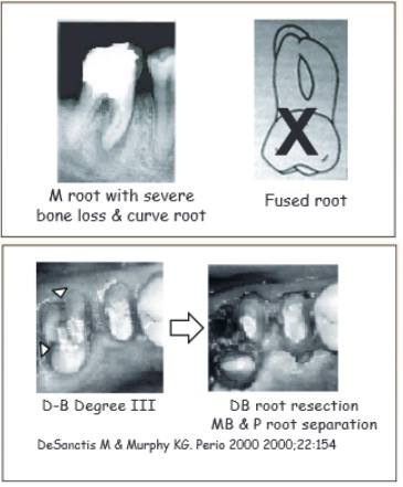 Thaiendodontics - Furcation Management ข้อบ่งชี้การทํา Root Resection ...