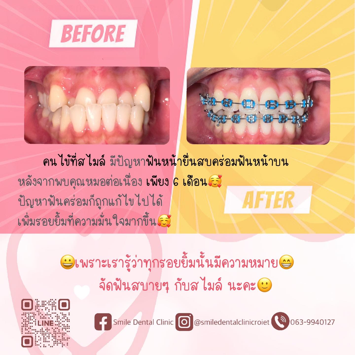รีวิวเคสจัดฟัน 🦷ฟันหน้าล่างคร่อมฟันบน🦷 นอกจากจะก่อให้เกิดปัญหาทางด้าน ...