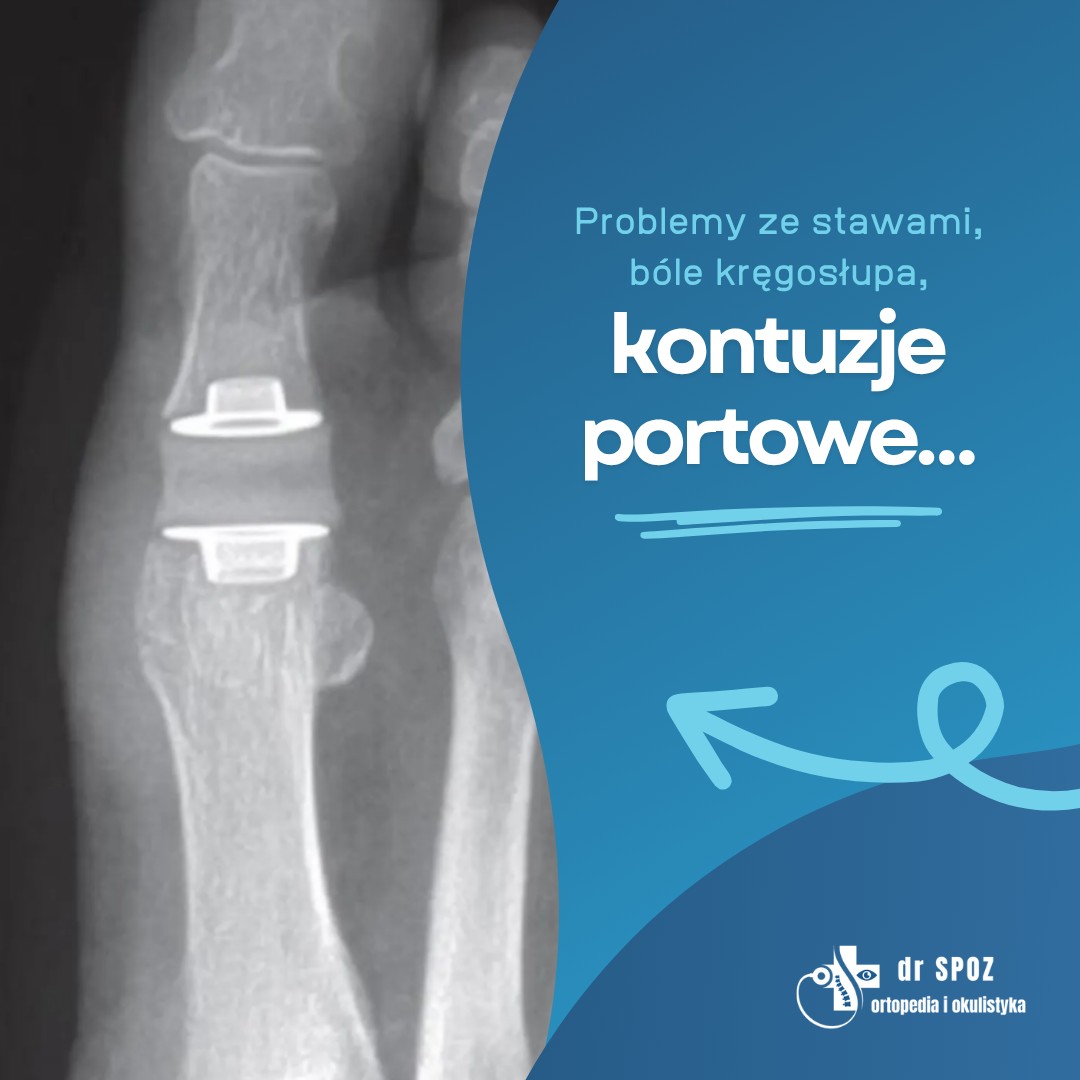 DR SPOZ Ortopedia i Okulistyka - Leczymy nadpotliwość! 💦 Męczysz się ...