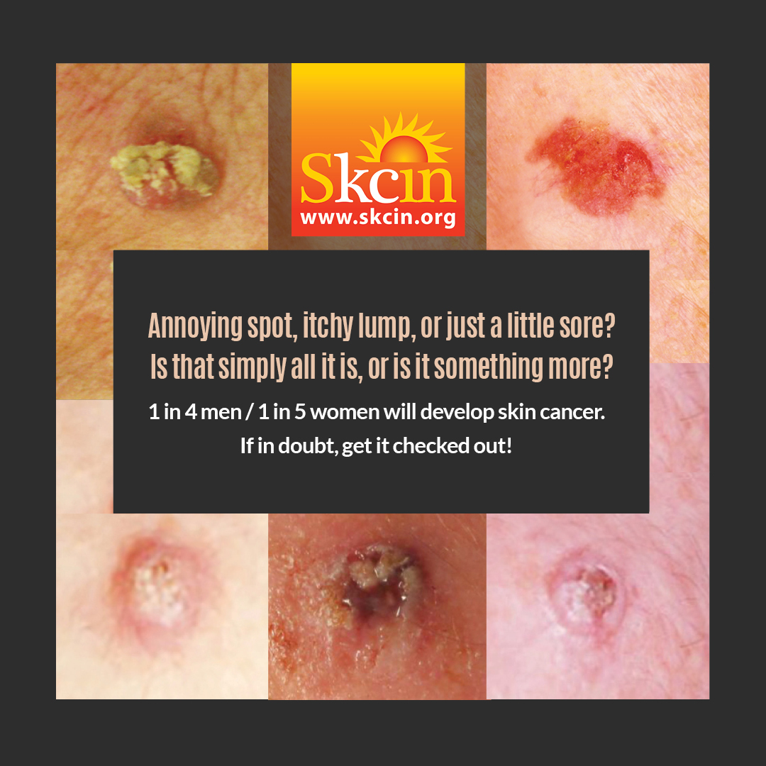 non melanotic malignant neoplasm of the skin Nonmelanoma Cancers You Need to Know Familial skin cancer syndromes: Increased
