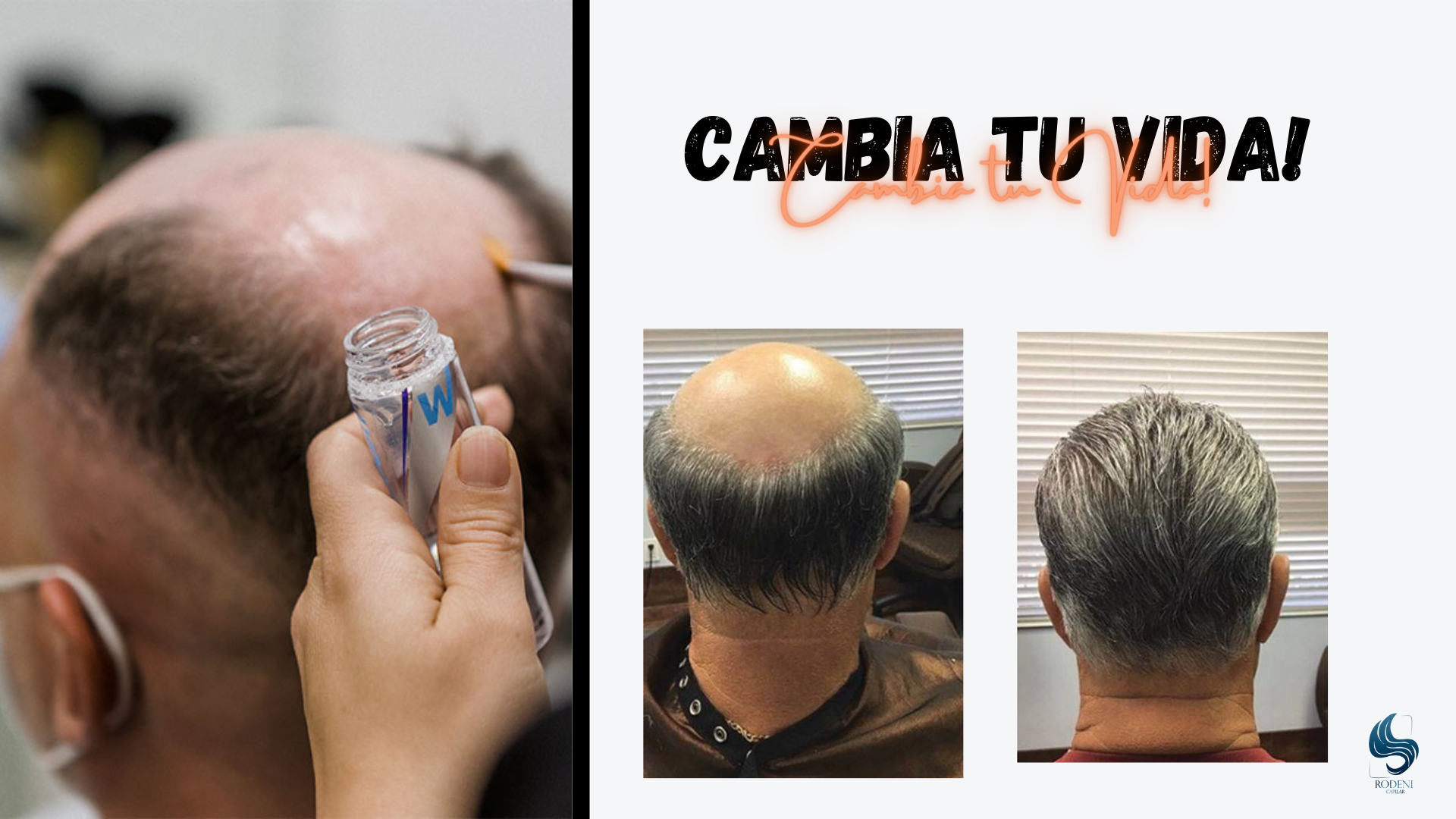 Rodeni Prótesis Capilares Puebla | Puebla