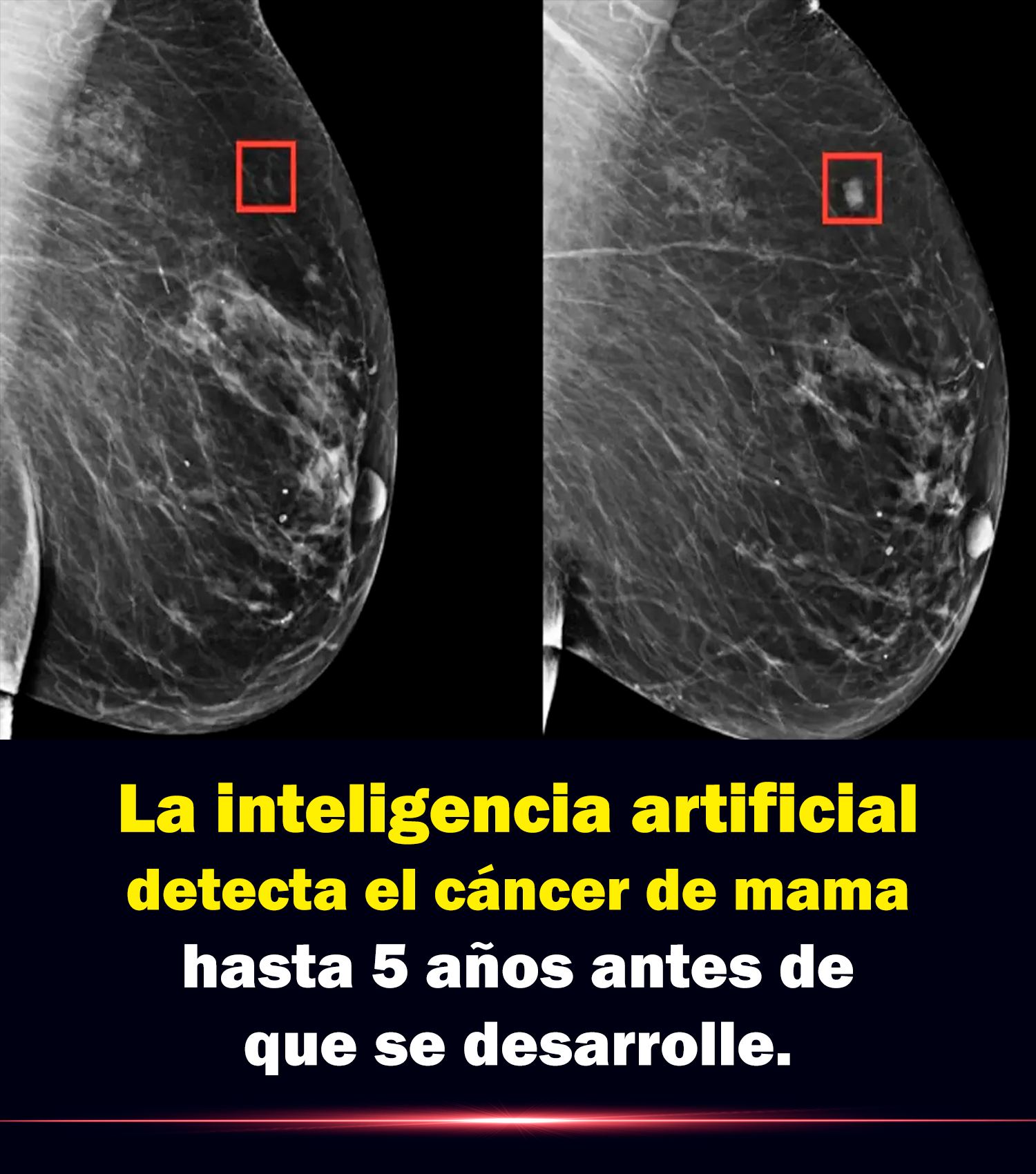 Cáncer de mama