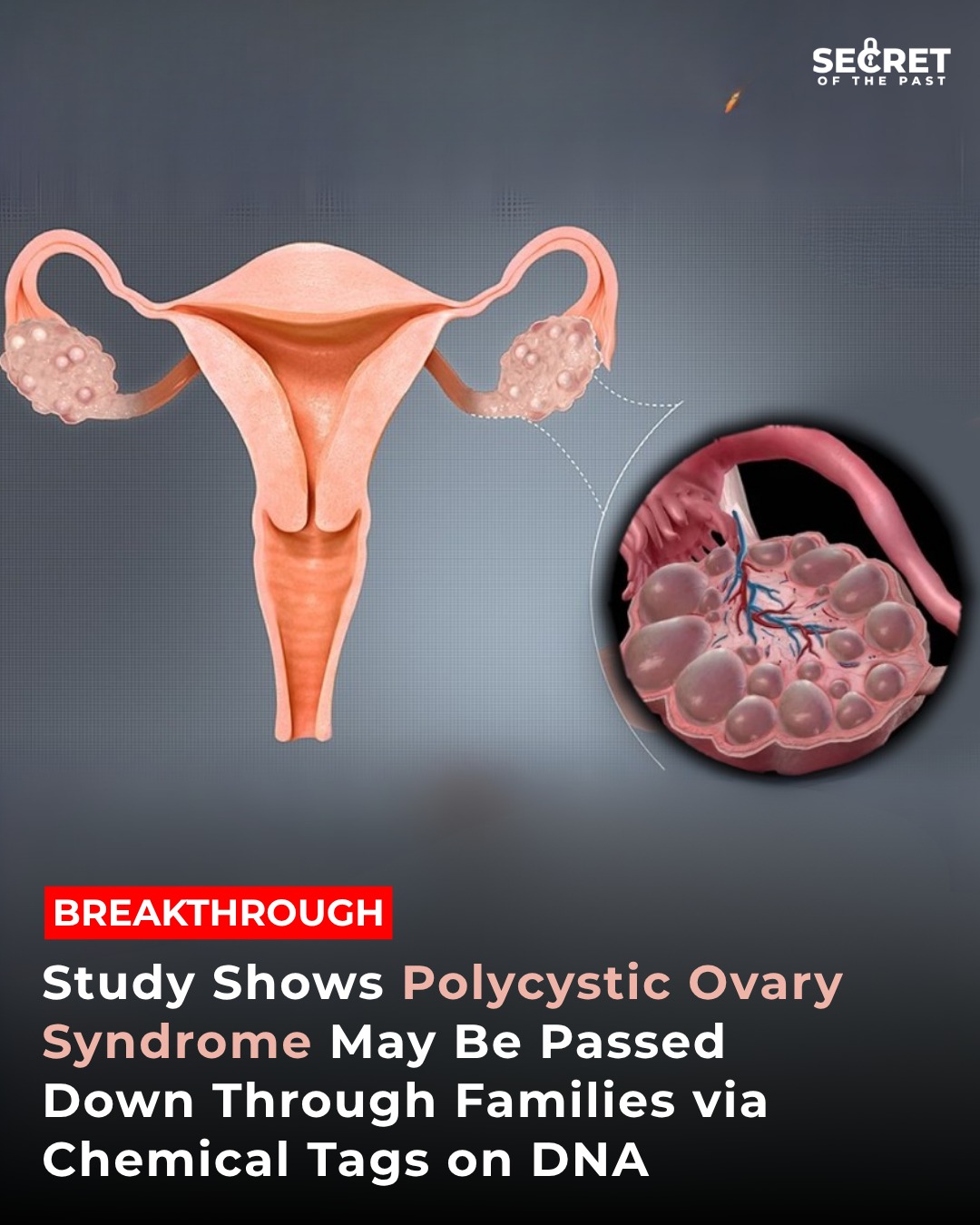 New - Groundbreaking Research Reveals Epigenetic Link in PCOS ...