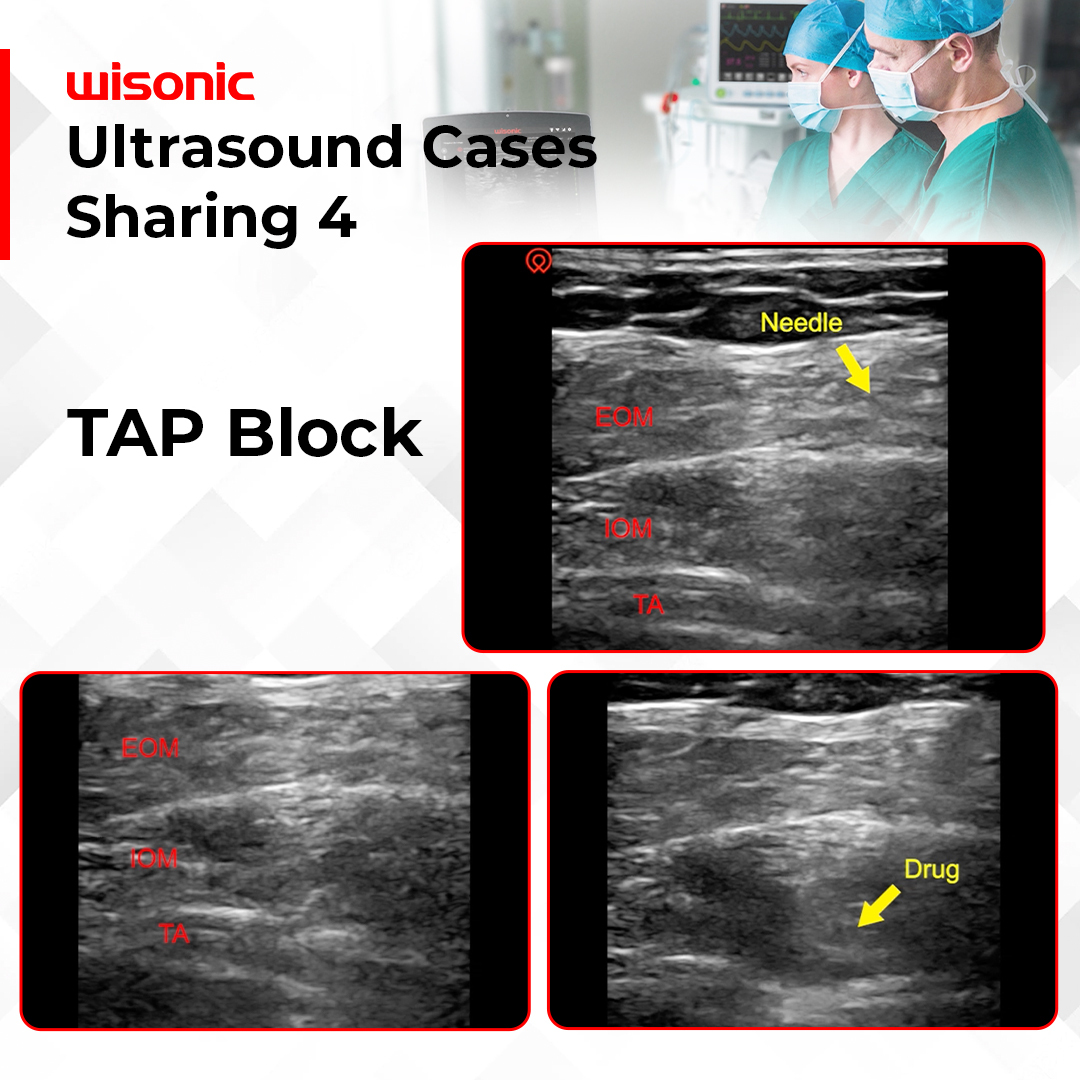 Wisonic Medical - 🎥 Check out latest video for an in-depth... | Facebook
