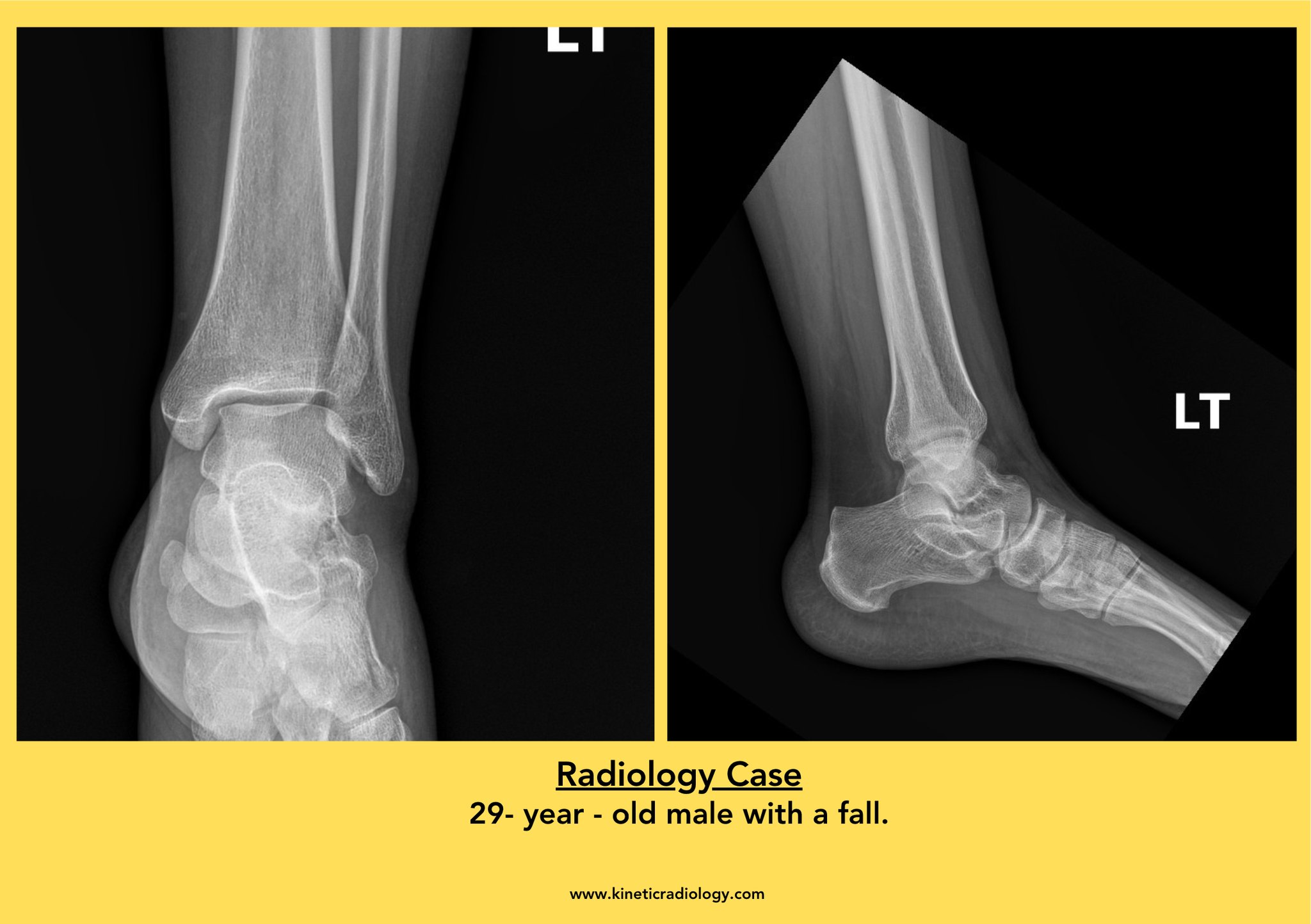 Kinetic - Radiology Case of the Week! 🩻 Hx: 29-year-old male with a ...