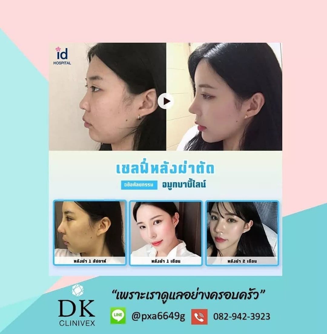 Seoul.surgery - รีวิวศัลยกรรมเกาหลี โรงพยาบาลไอดี 👉🏻... | Facebook