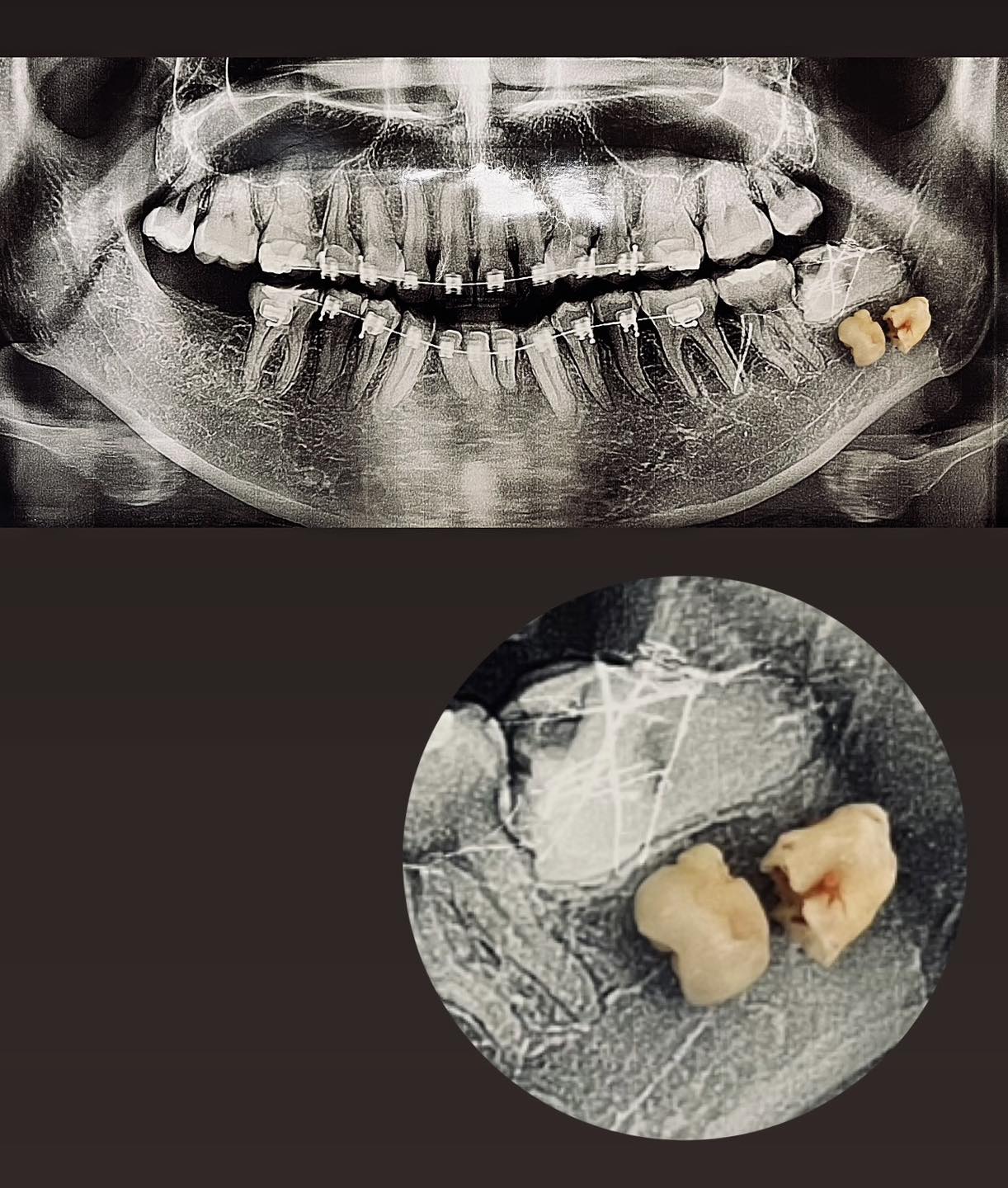 Rogers - Odontectomy is a surgical procedure to remove a tooth (often ...