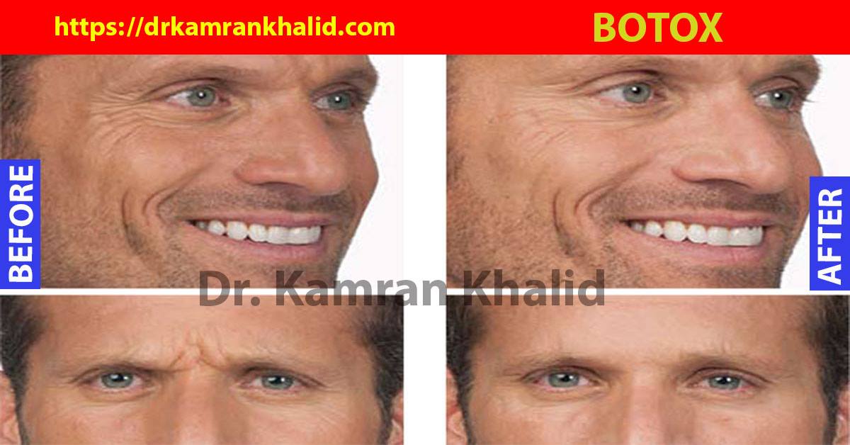 Botox injection is the medicine... - Prof. Dr. Kamran Khalid | Facebook