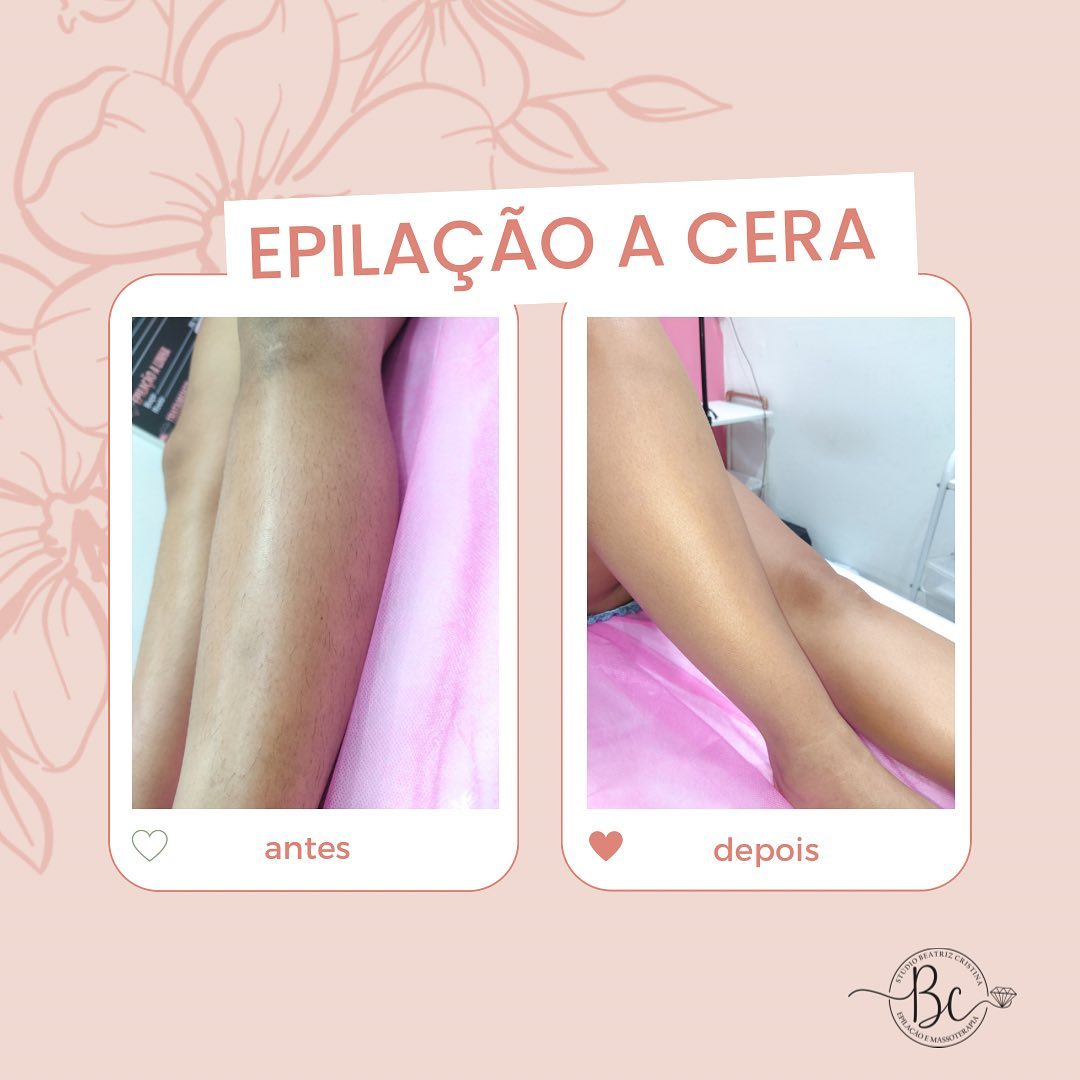 Studio - Antes e depois de uma depilação de perna: a diferença é ...