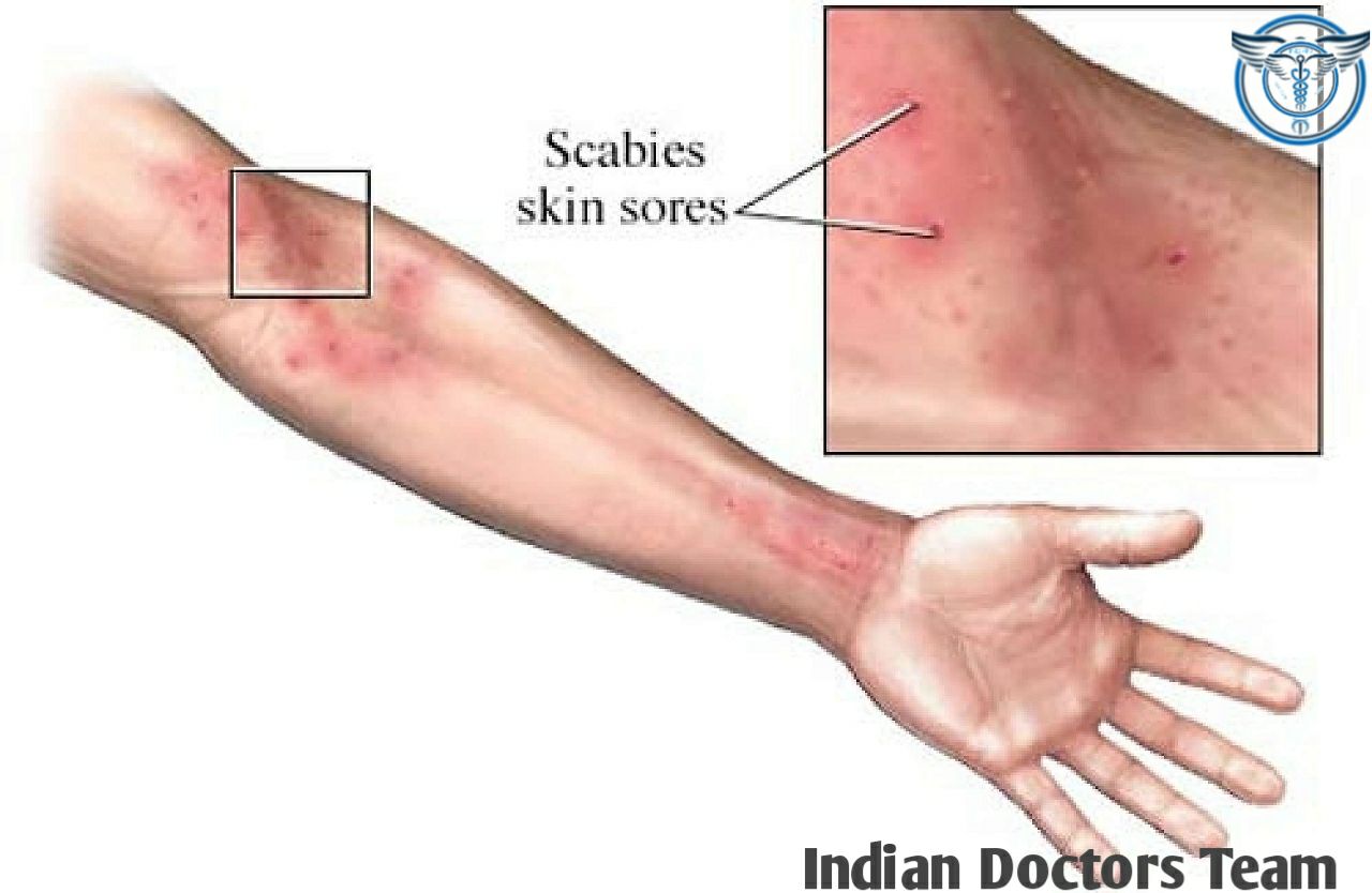 Indian - Scabies is a parasitic infestation caused by tiny mites that ...