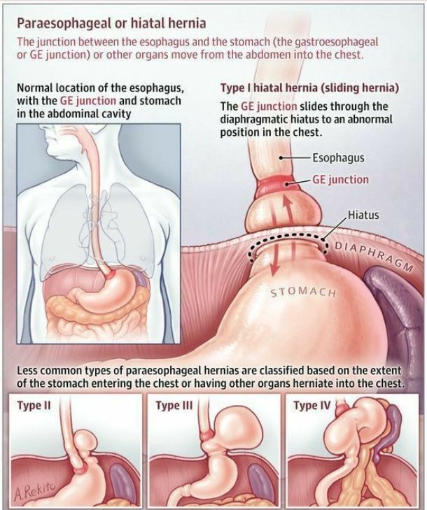 hiatal hernia and semaglutide Gastric Sleeve Repair Best Bariatric Surgery for Hiatal