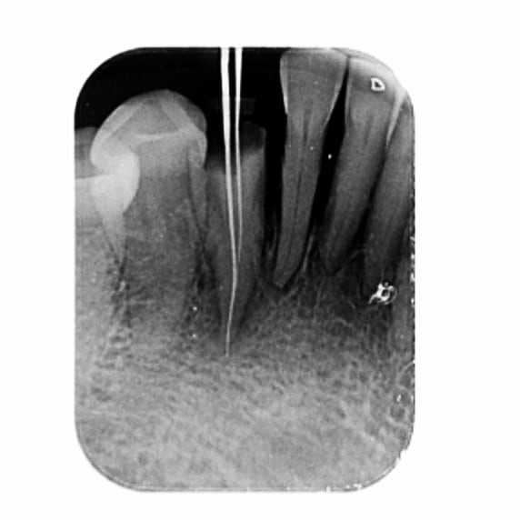 Type 2 RC SWIPE ️👉 Sorry for poor... - Magnum dental care