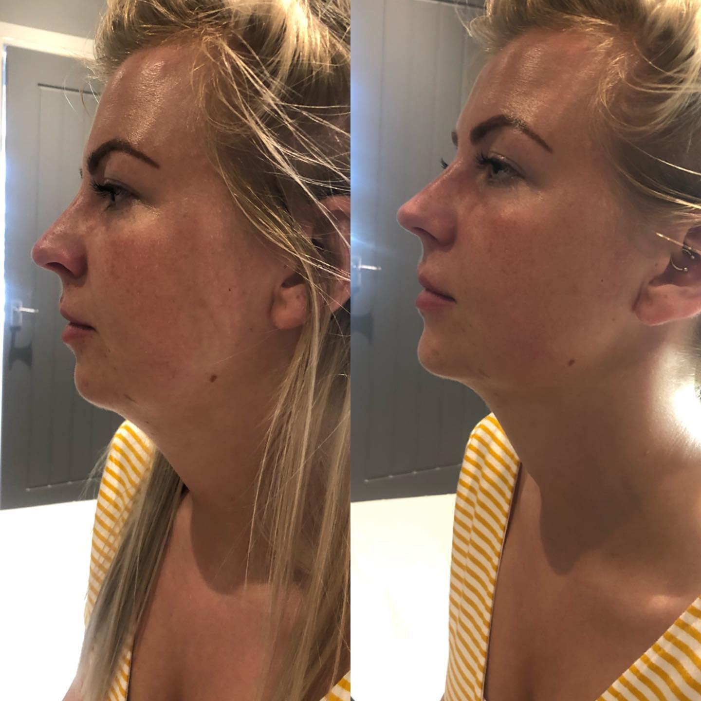 Novo cosmetics - Look how by tweaking your chin can give...