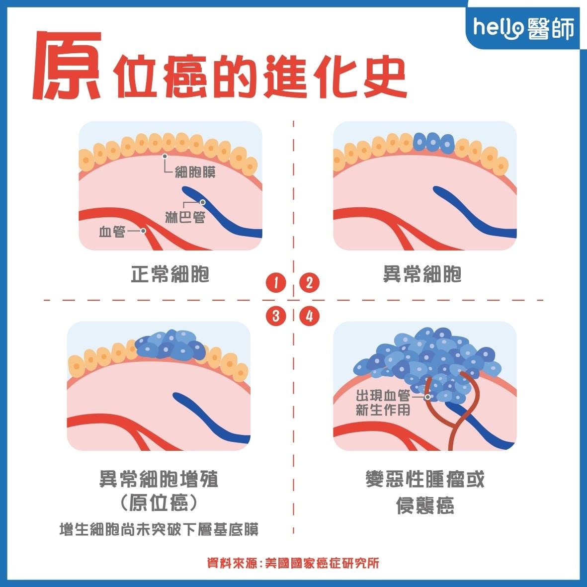 Hello醫師 - 👩‍⚕️原位癌是什麼？剖析癌症進化史 完整解析請看 ️... | Facebook