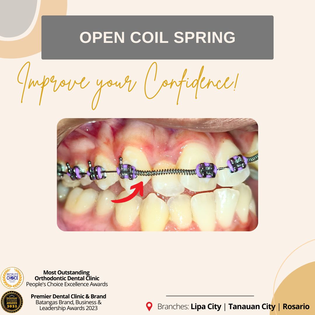 Pangilinan - Open coil springs are specialized orthodontic devices that ...