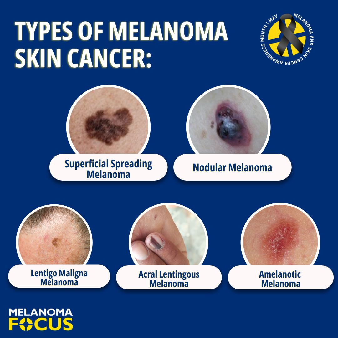 Melanoma Focus - What are the different types of melanoma...