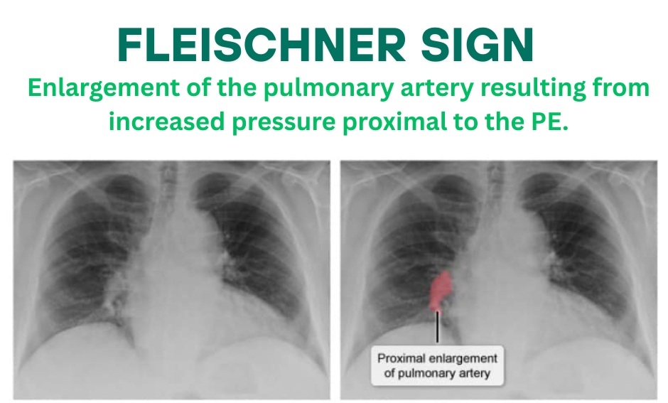 IV Notes - ما هي علاقة ال Chest x-ray بال pulmonary... | Facebook