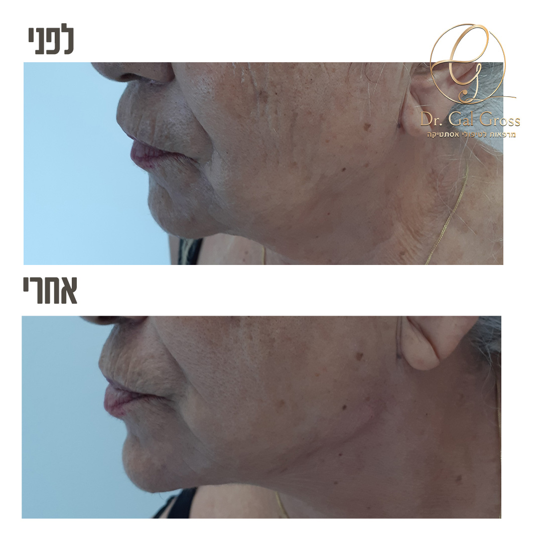 לסת... - Dr. Gal Gross Aesthetic Medicine - ד