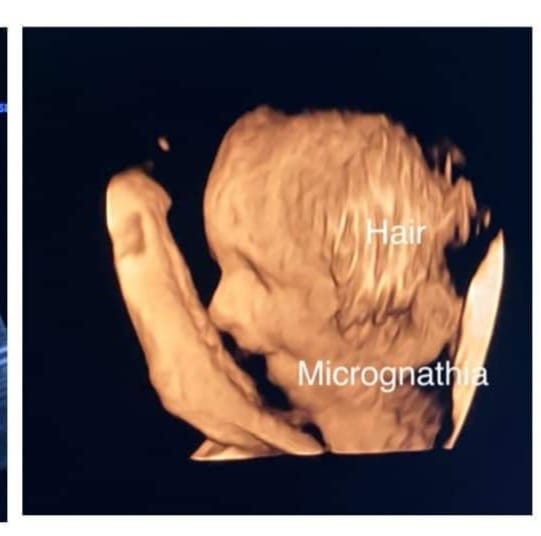 Scan Academy Four Chamber View Anomalies Dr Rabih Chaoui Colour Doppler ...