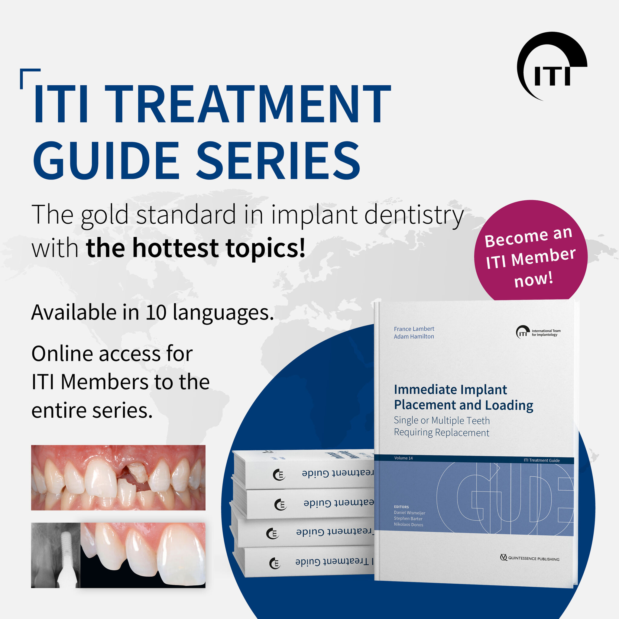 ITI Treatment Guide : Japanese Volume1 商品の説明ITI Treatment Guide…