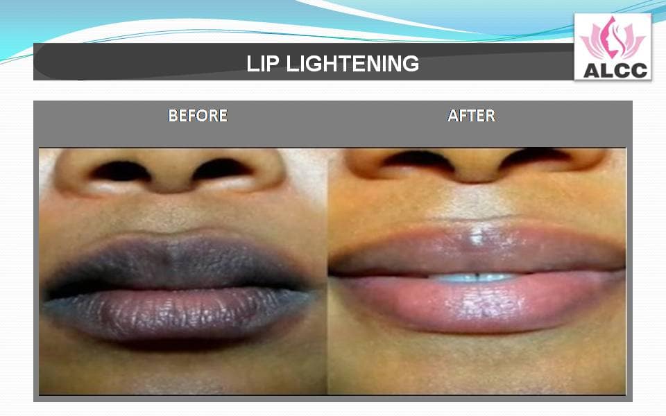 after effects imporeiting c lips black Lip color varies person to person. may also appear darker due to sun damage, nutritional deficiences or smoking. Dark lips are not a sign of an underlying health condition unless the Ingredients_Antioxidants