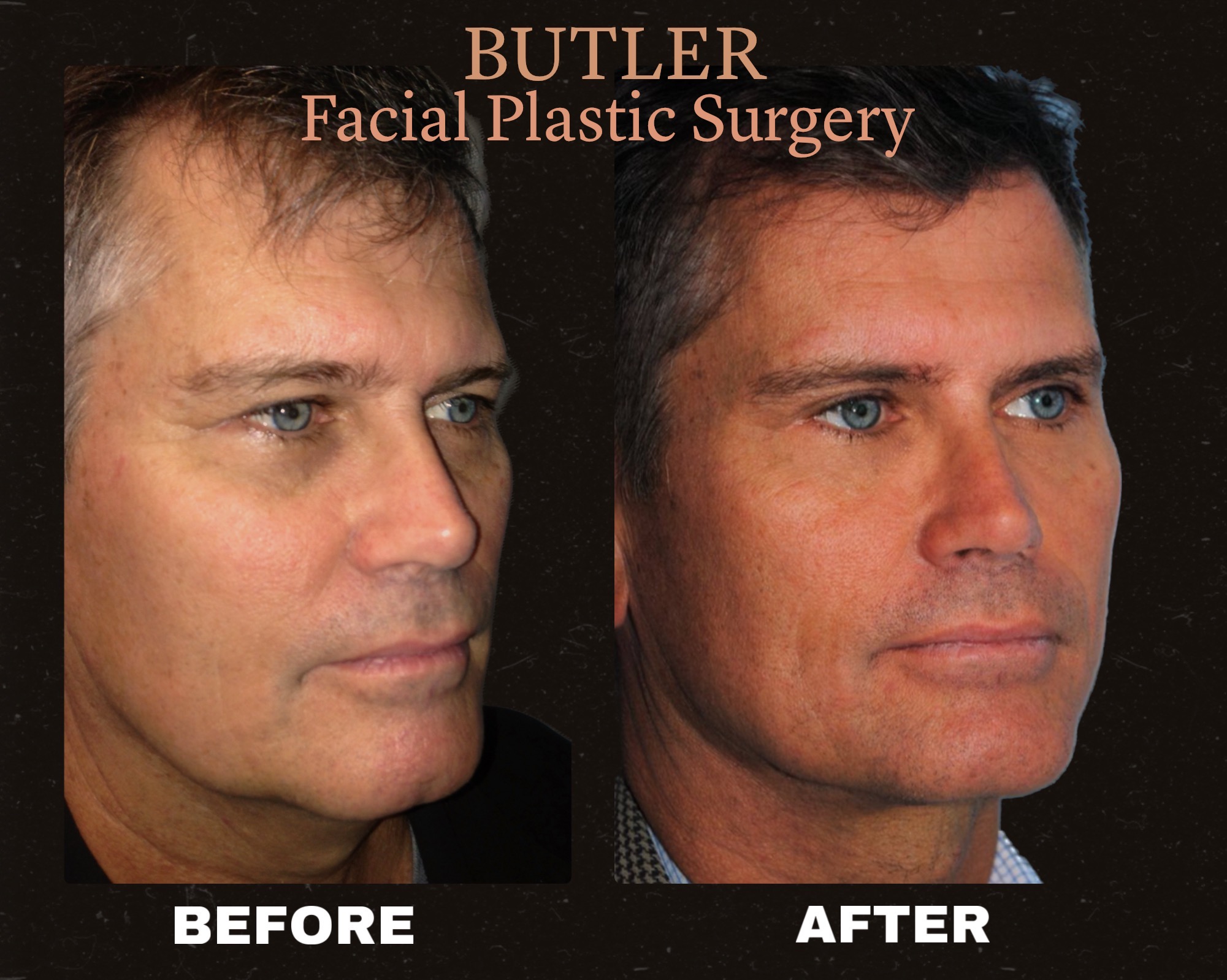 Butler Facial Plastic Surgery | Santa Monica CA