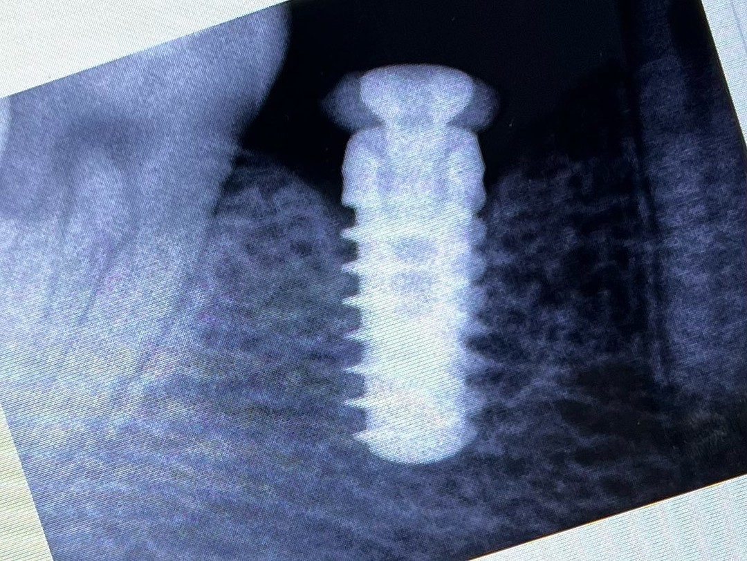 Condent - Te haz preguntado qué es un implante dental 🦷 🔩...