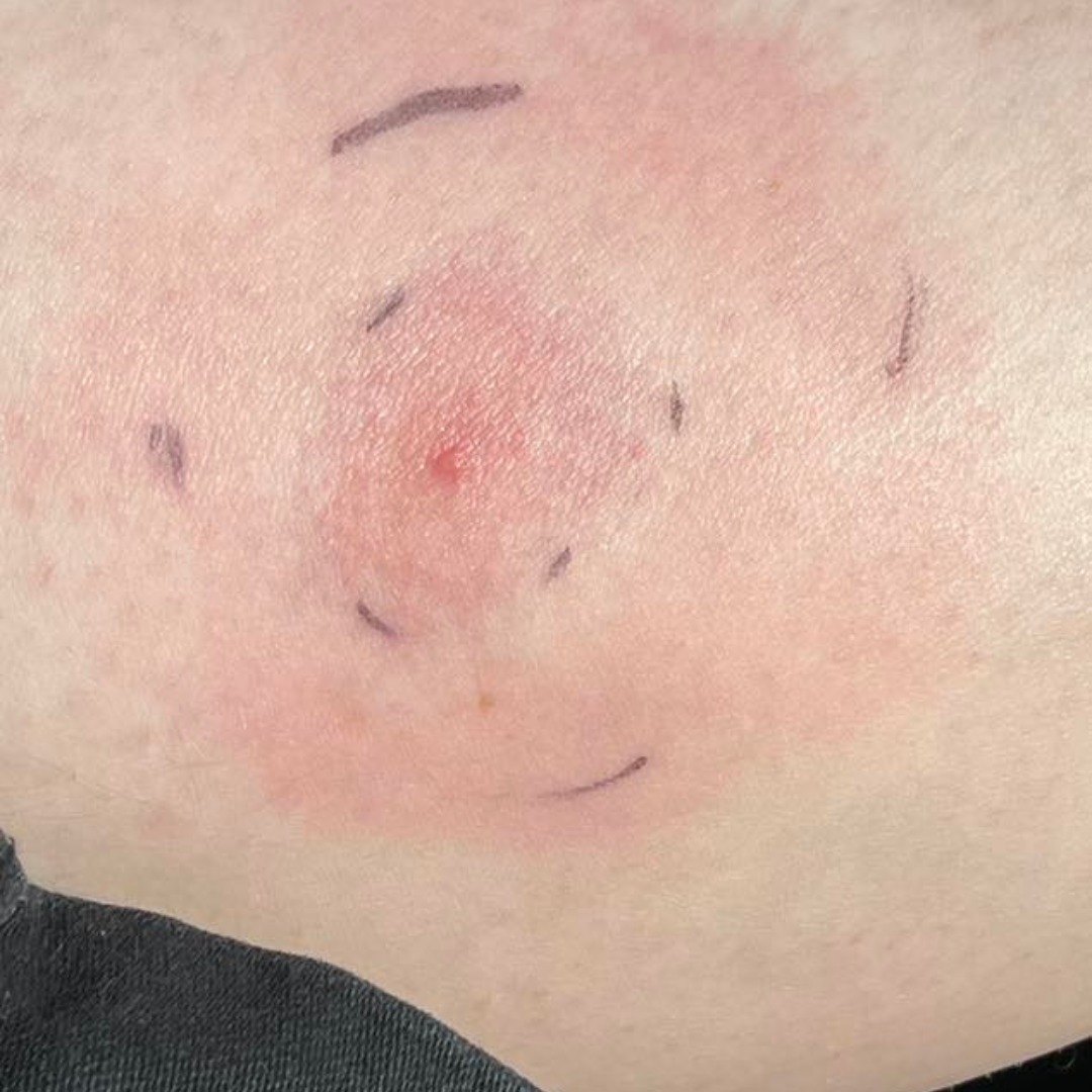 Lyme Disease UK - An EM rash is a key early sign of Lyme... | Facebook