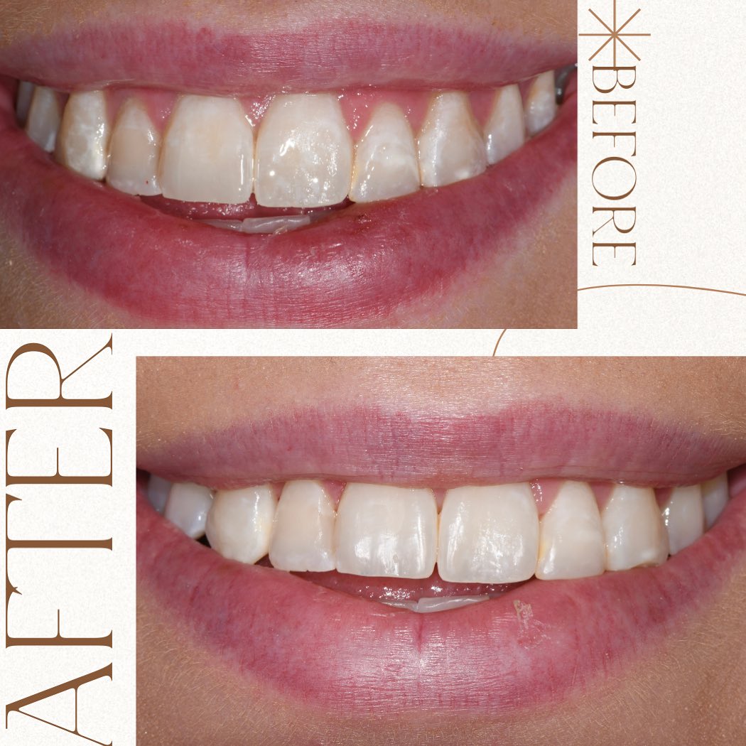 White spots on your teeth? These might be decalcification areas, which are the first sign your enamel is losing minerals. Common causes: plaque, braces, sugary foods, low fluoride, and more! They're mostly
