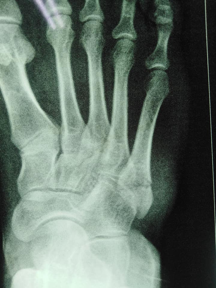 Today's work dancer fracture... - Radiology Students Of A.M.S