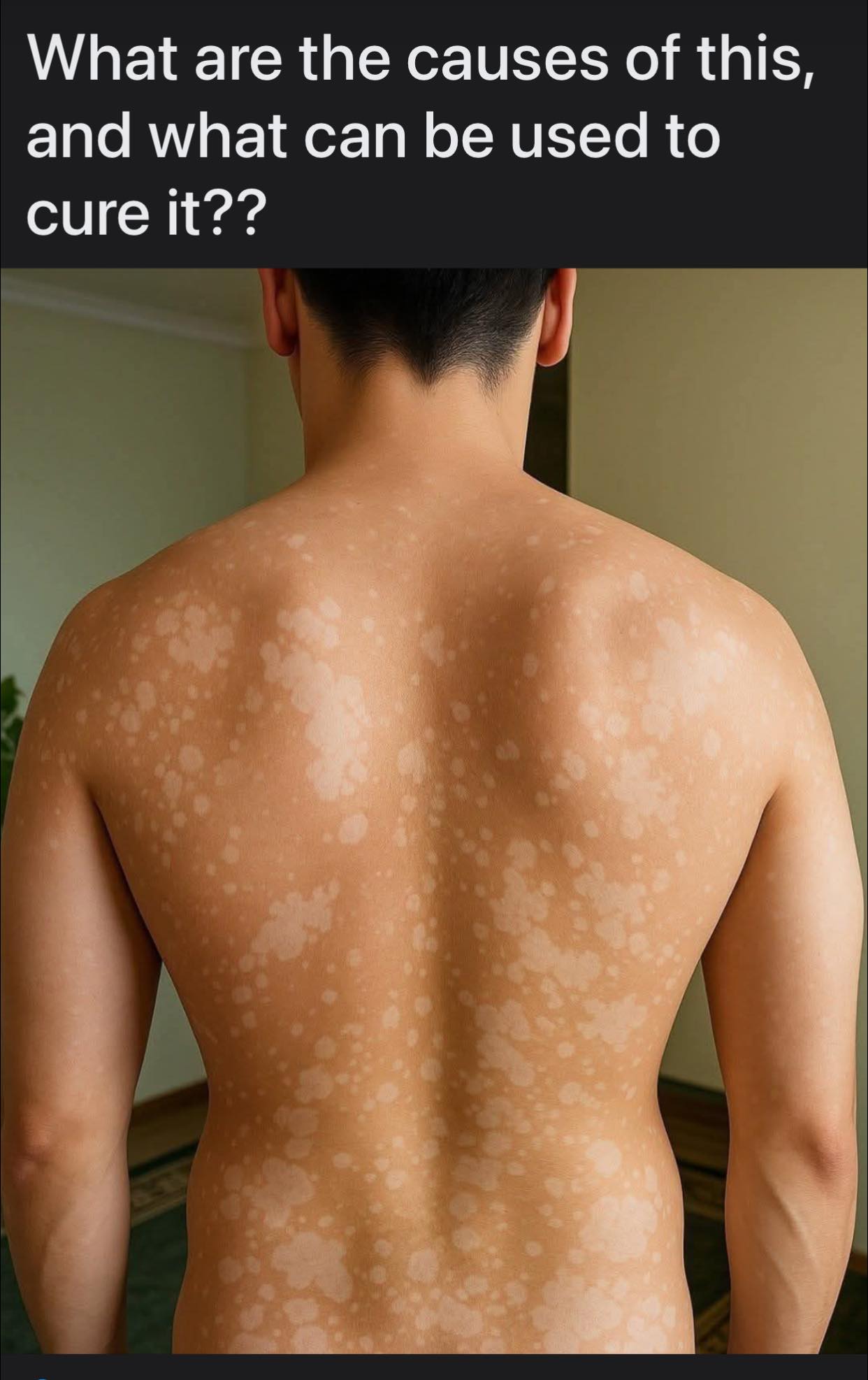 How to treat Tinea Versicolor?
