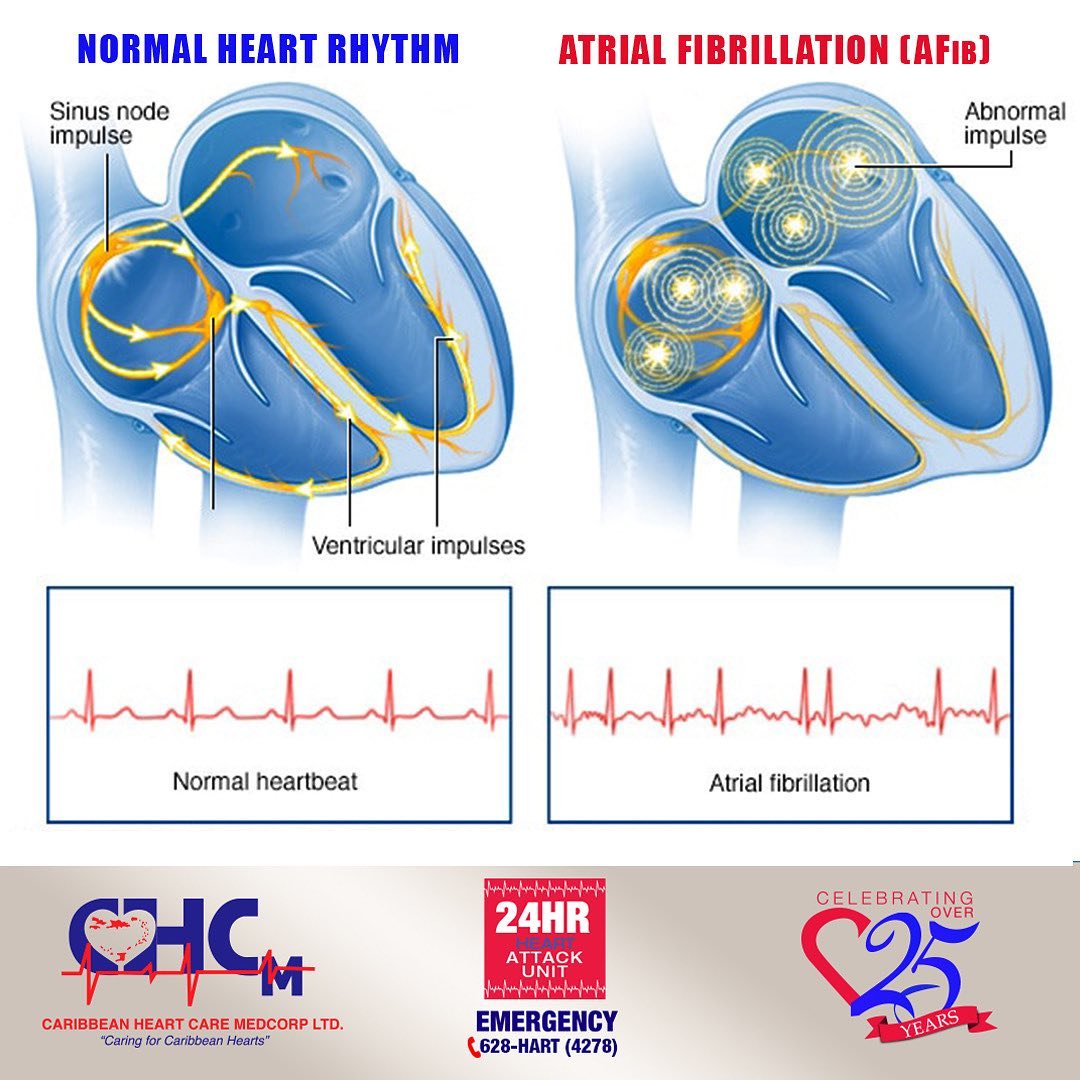 Atrial fibrillation, often... - Caribbean Heart Care Medcorp | Facebook