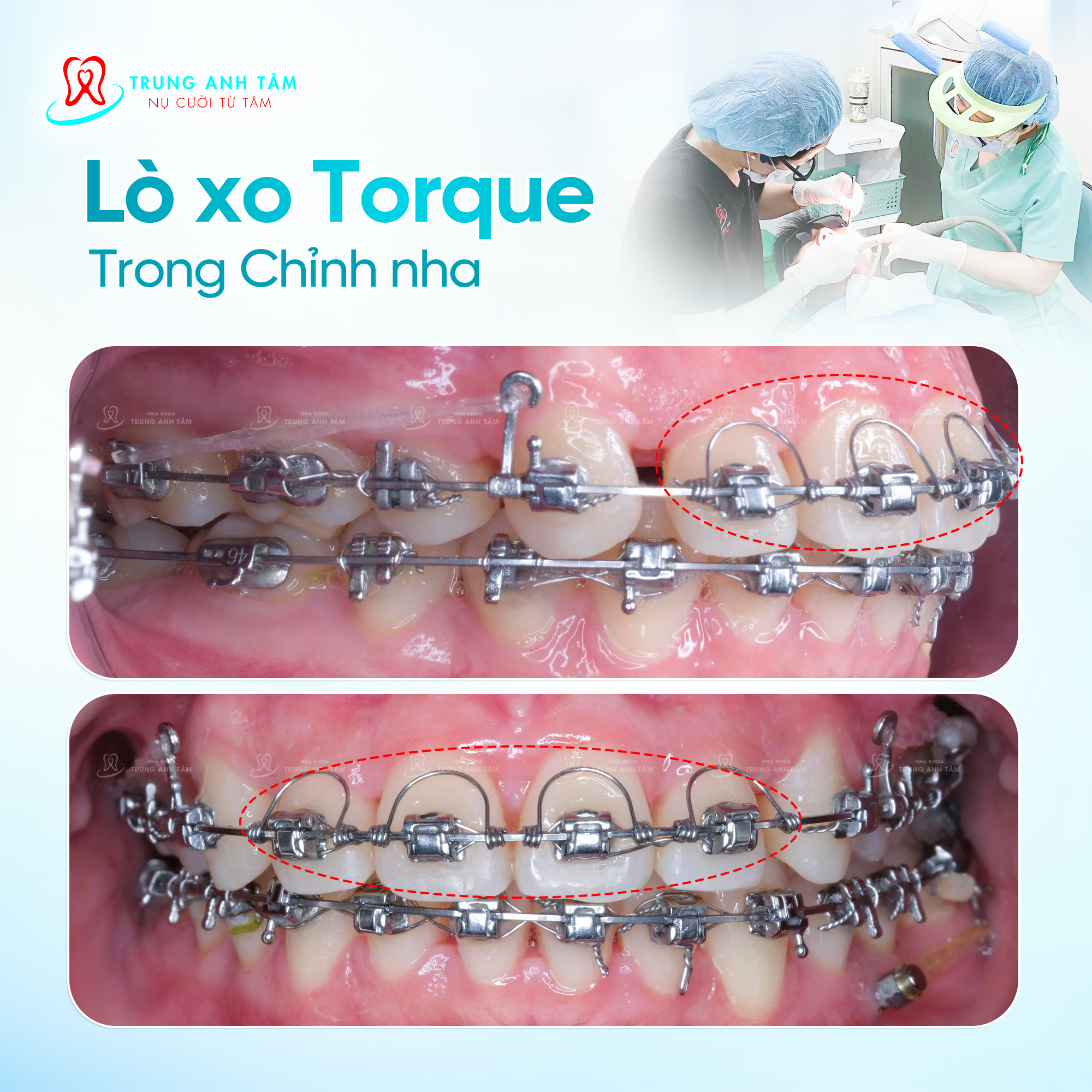 Nha - LÒ XO TORQUE TRONG CHỈNH NHA 🔹 Trong quá trình chỉnh nha, việc ...