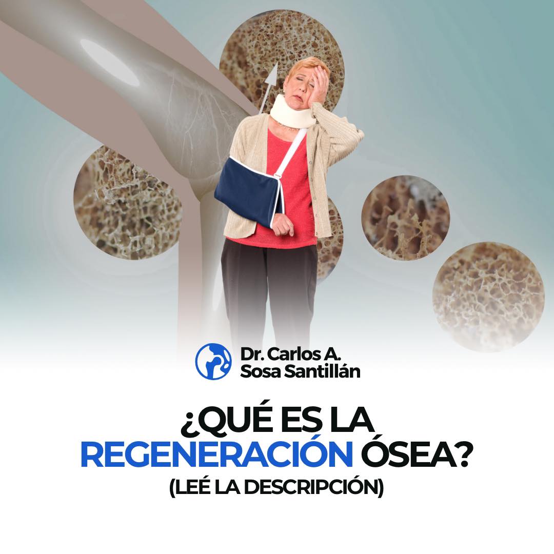️ La regeneración ósea es el proceso natural de curación de huesos ...