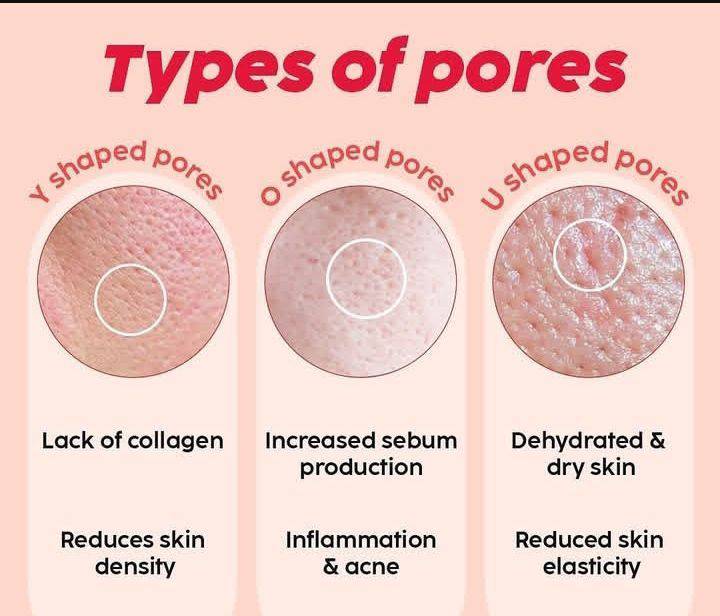 Life - Types of Facial Pores: 1. Open Pores: Visible, enlarged pores ...