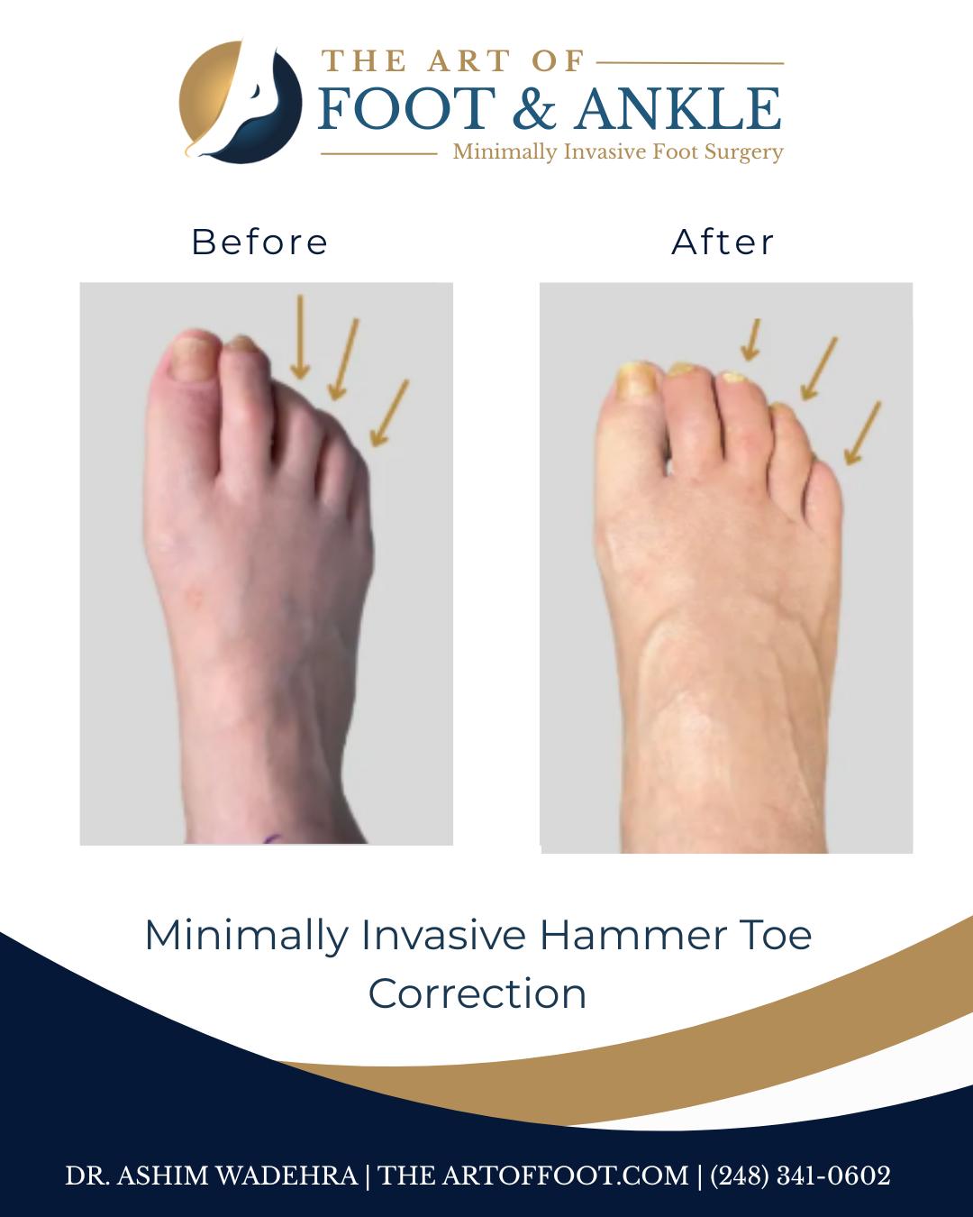The Art of Foot & Ankle - Minimally Invasive Surgery | Facebook