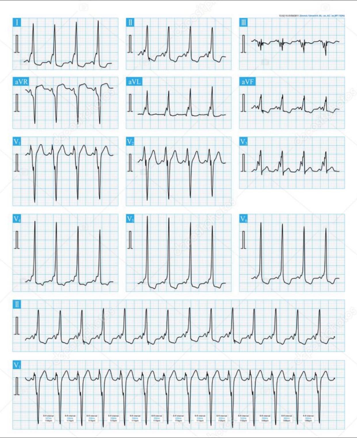 CCU - B-Type Preexcitation with Sinus Tachycardia #CCU_ECG...