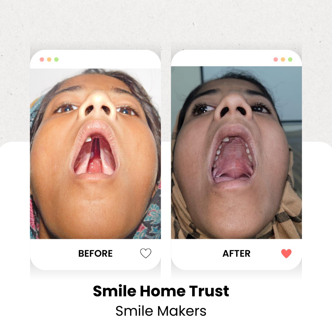 Free Cleft Lip and Cleft Palate Surgery... - Smile Home Trust | Facebook