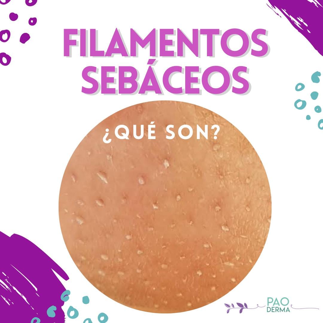 Pao - Los puntos negros son comedones abiertos (espinillas) que se ...