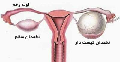 اسدالله - کیست تخمدان چیست علل به وجود آمدن و راه های درمان : کیست ...