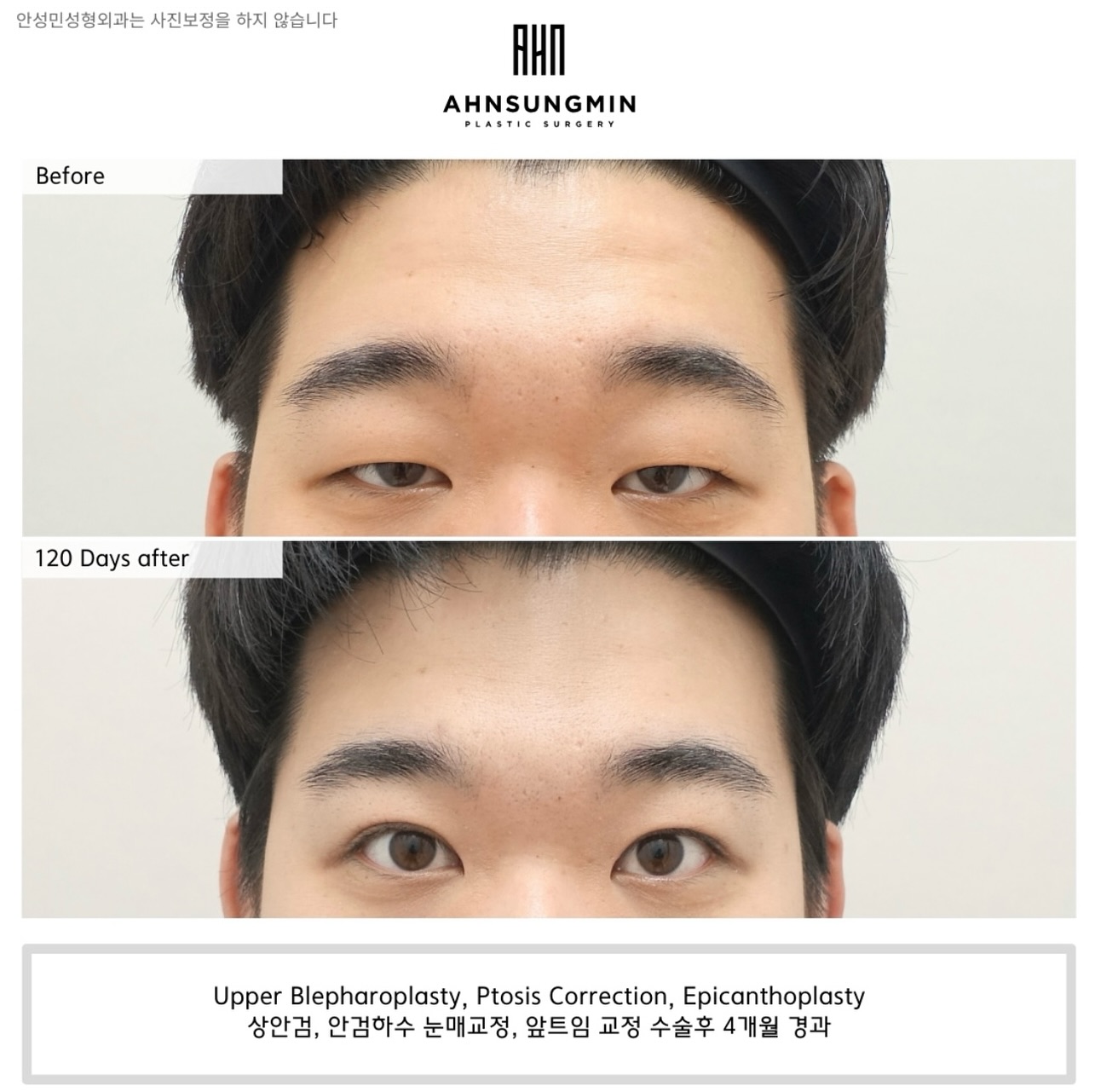 Sung Hanbin Plastic Surgery