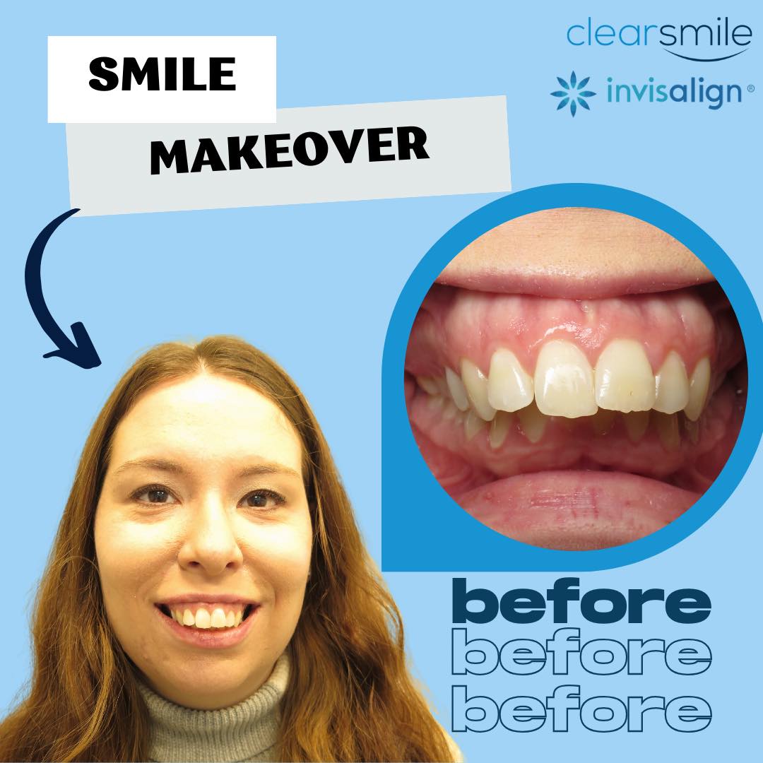 Clearsmile - 👀 What a smile transformation! With... | Facebook